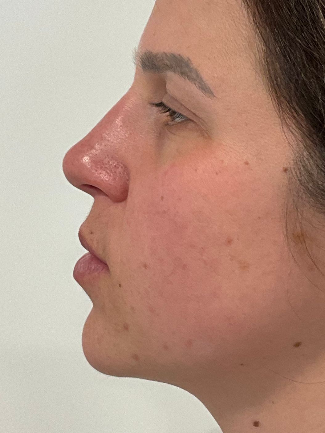 Nose and chin Dermal filler after