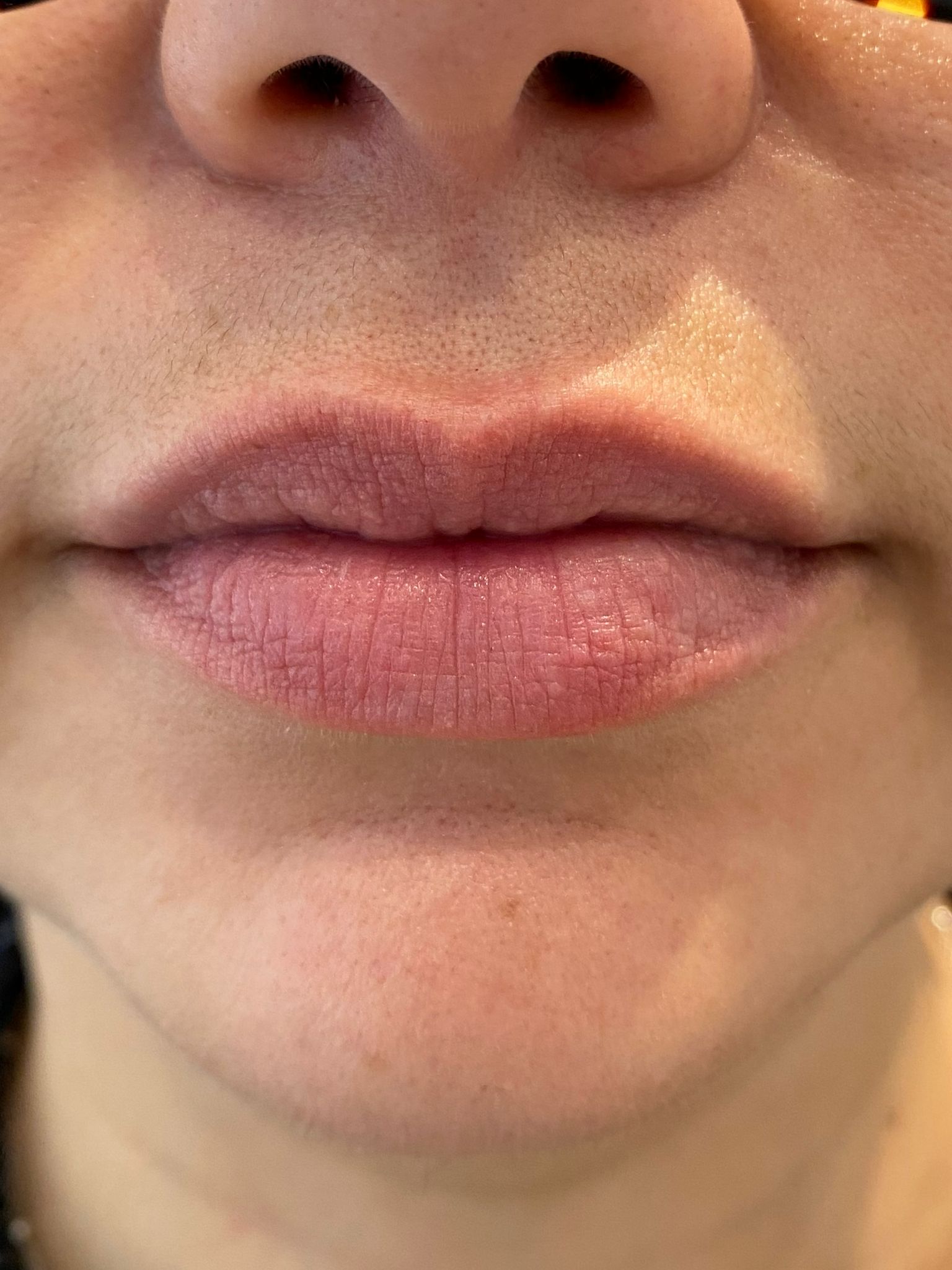 1- Lip dermal filler before