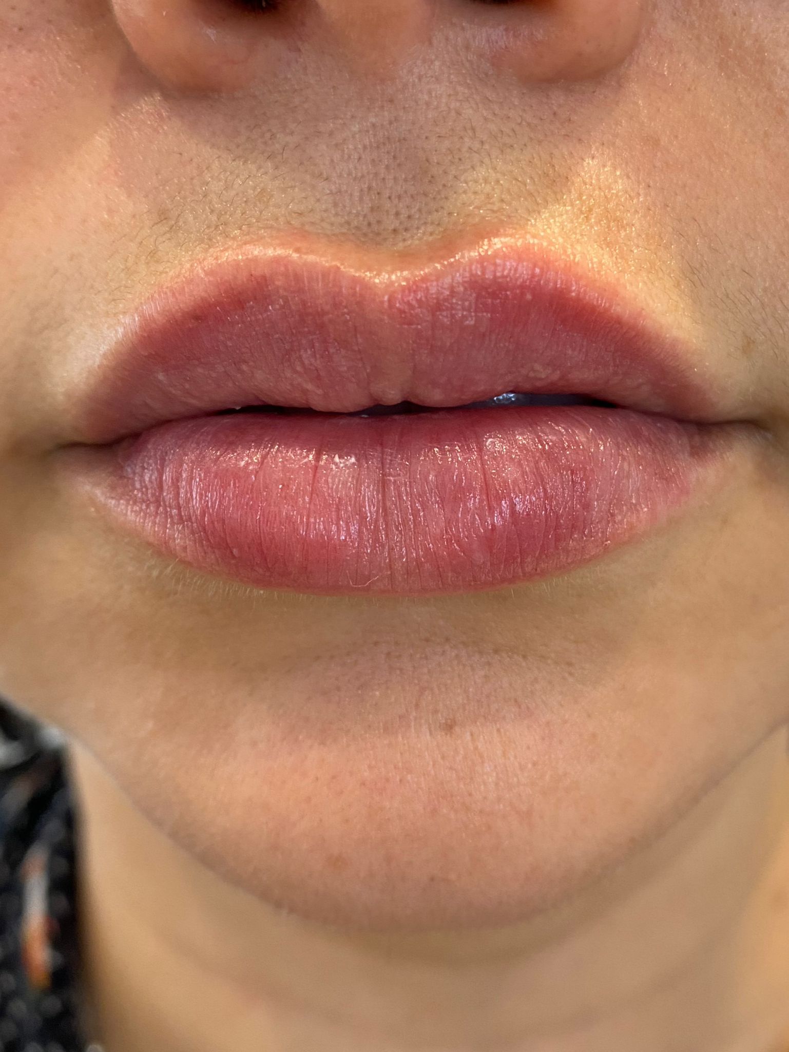 1- Lip filler after