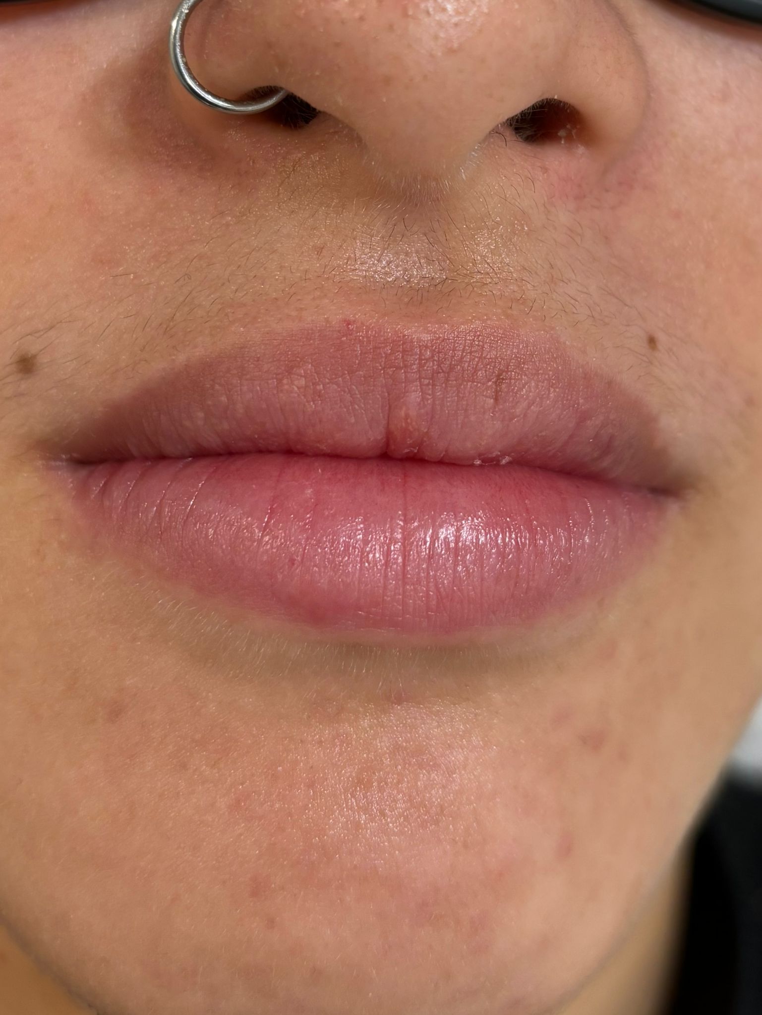 Lip dermal filler before