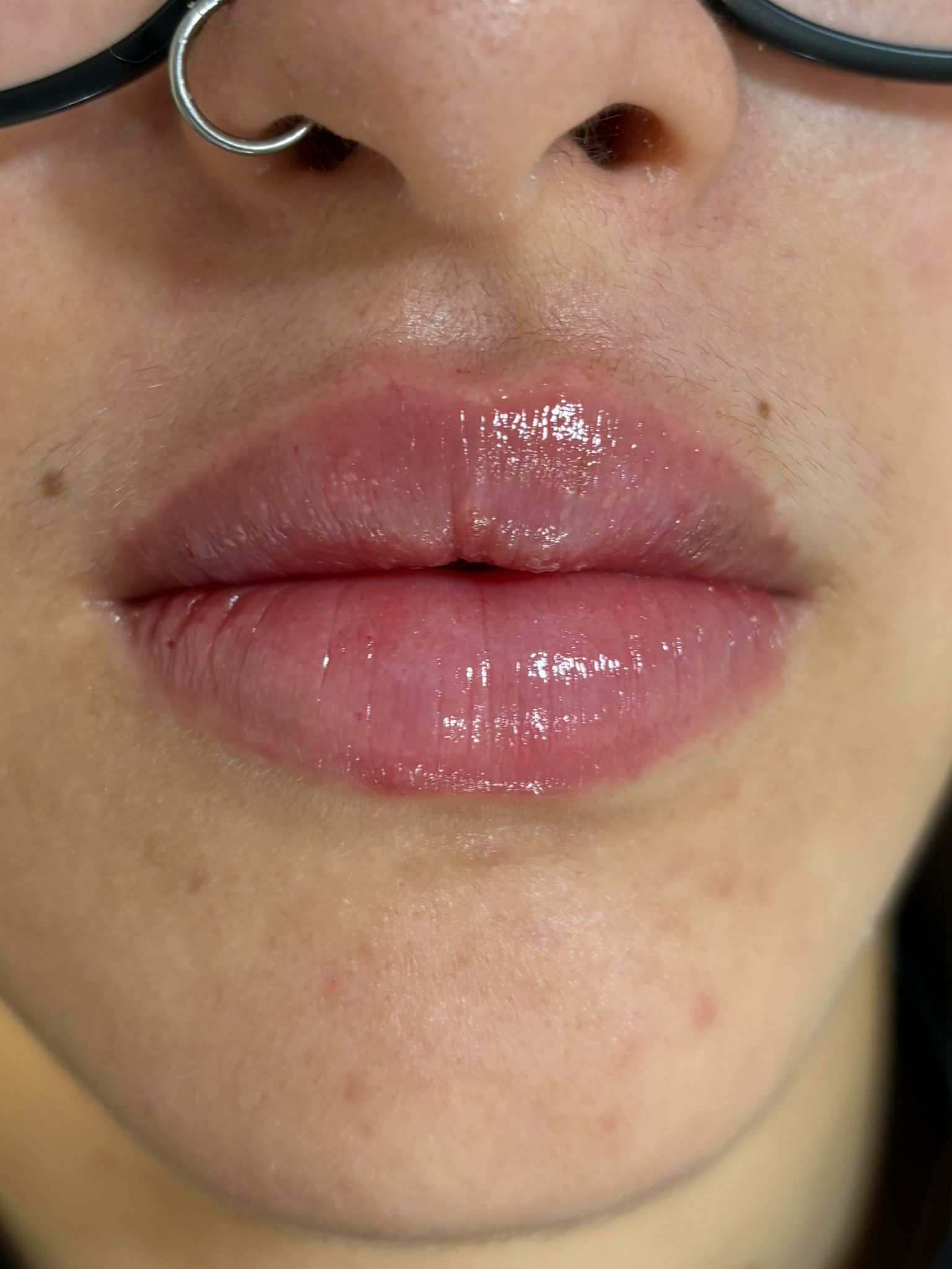 Lips dermal filler after